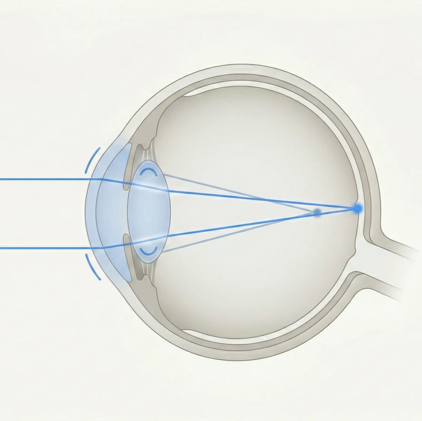 屈折矯正の参考画像