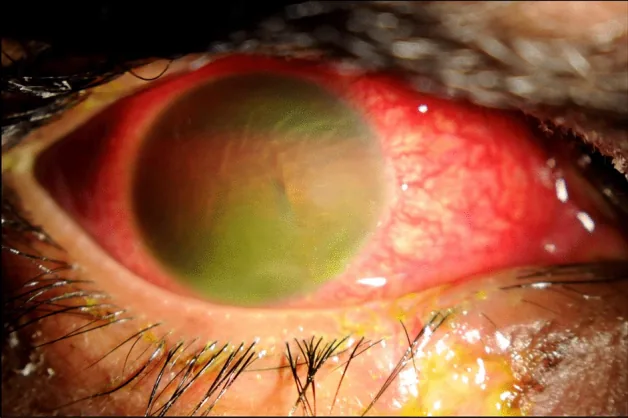 前房出血が前房を満たした眼の細隙灯写真