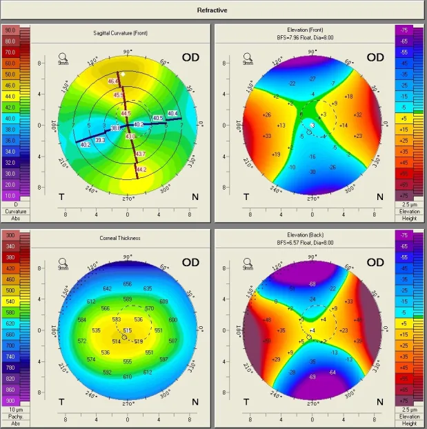 Motivo asimmetrico a farfalla nell'analisi della forma corneale