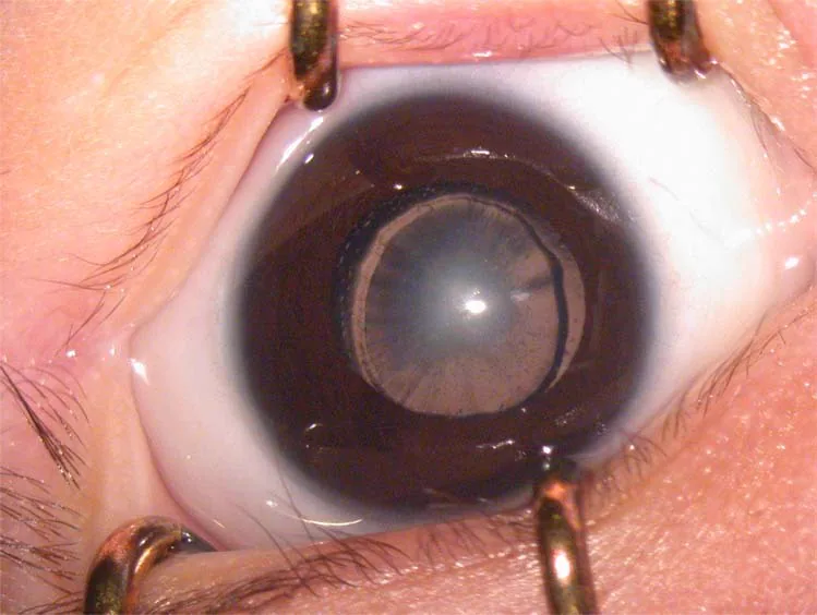 先天白内障の前眼部写真。瞳孔内に水晶体核の白色混濁を認める。