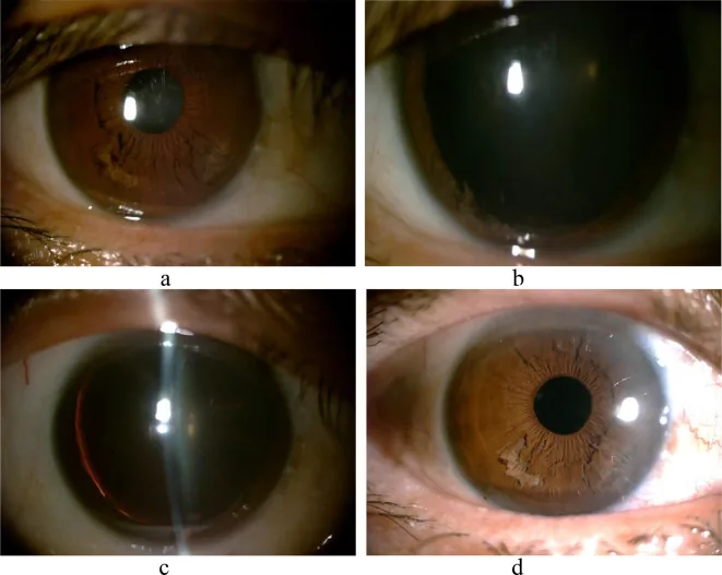 Fotografía con lámpara de hendidura de iridosquisis. El estroma del iris está desgarrado y fragmentos fibrosos flotan en la cámara anterior.