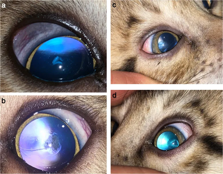 Various types of nuclear cataract associated with steroid use