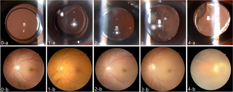 Slit-lamp retroillumination image of posterior capsule opacification and changes in fundus visibility as opacification progresses