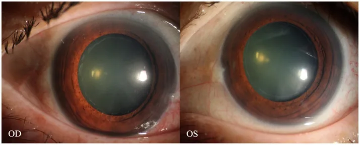 ภาพถ่ายส่วนหน้าของตาหลังขยายม่านตาในกลุ่มอาการเทียมหลุดลอก (pseudoexfoliation syndrome) พบสารเทียมหลุดลอกสีเทาขาวเป็นวงรอบแคปซูลเลนส์ด้านหน้า