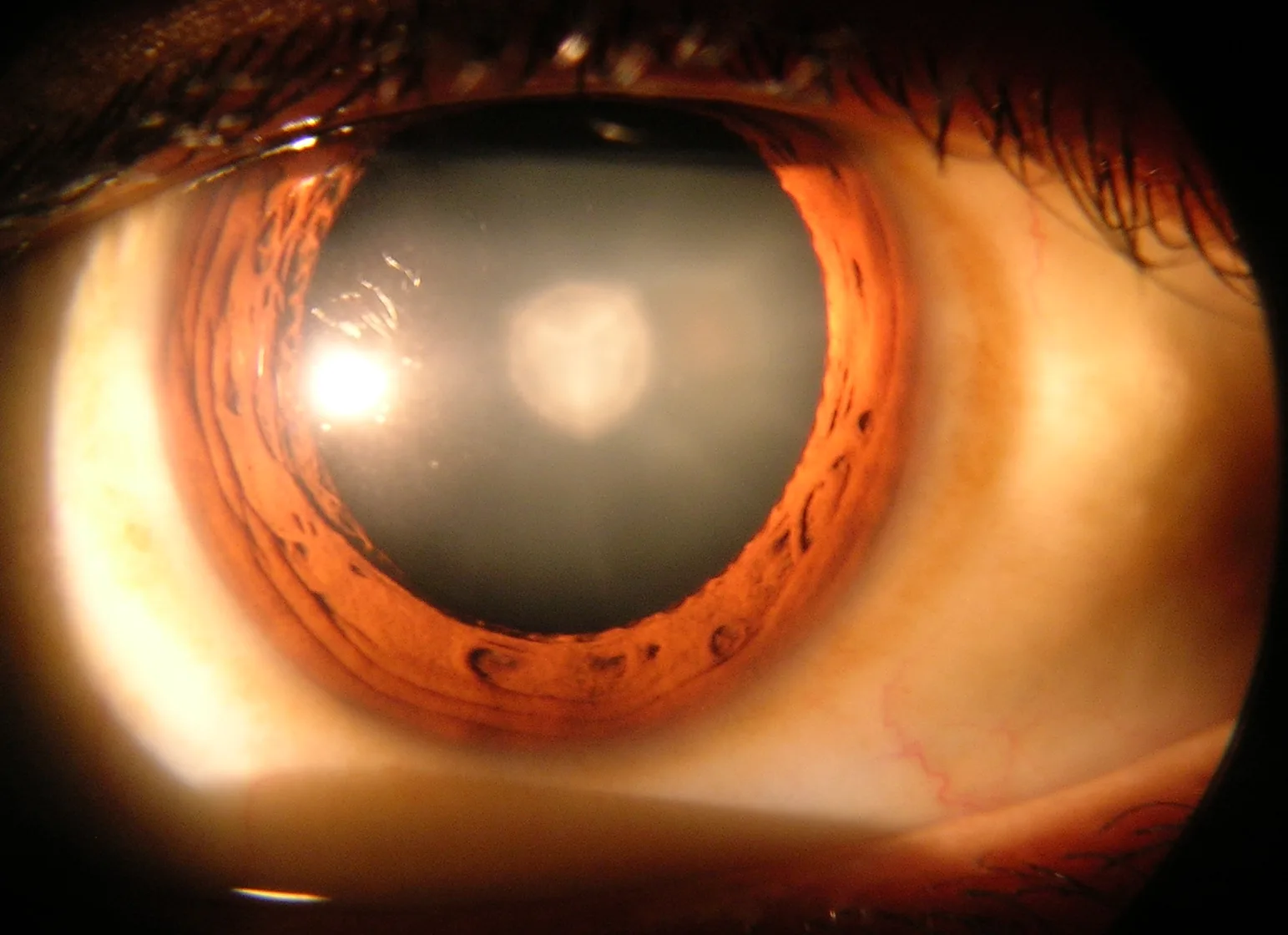 瞳孔全体が白く濁った成熟白内障（白色白内障）の眼の接写。褐色の虹彩の中央で、本来黒いはずの瞳孔領が灰白色に埋まり、奥の眼底が透けて見えない。