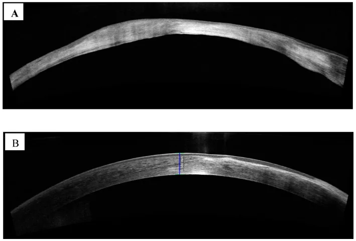 アカントアメーバ角膜炎後のSDAS-OCT
