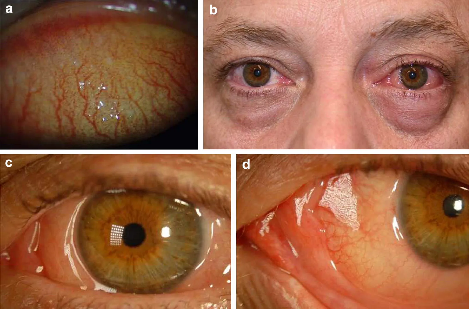 Klinisches Bild einer allergischen Konjunktivitis mit konjunktivaler Injektion, Chemosis und Lidödem