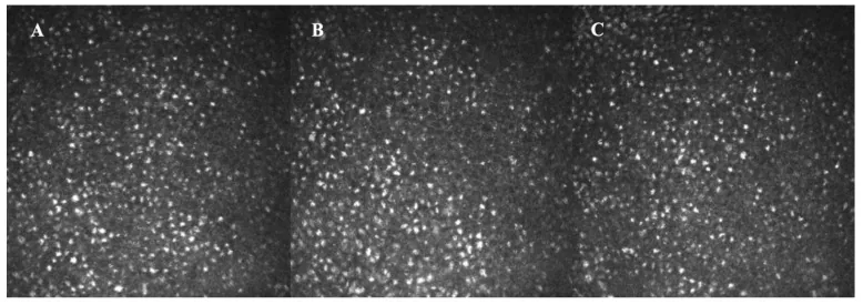 アマンタジン誘発角膜浮腫のIVCM所見