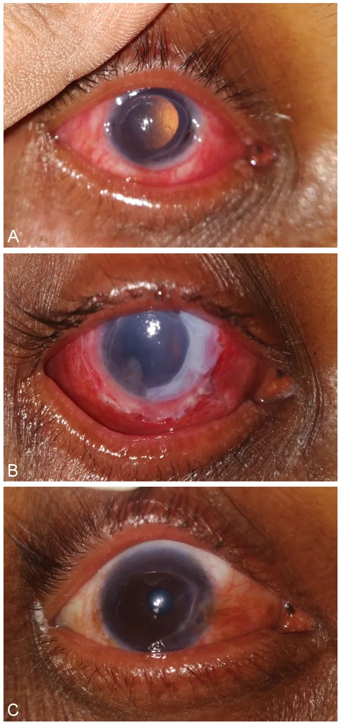 羊膜移植前後の前眼部写真