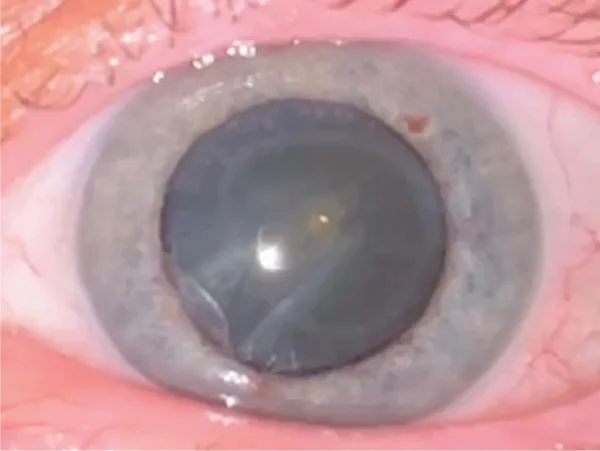 散瞳した左眼の前眼部写真。瞳孔の縁に沿って角膜中間周辺部に灰白色の細い環状混濁（アッシャー・リング）が見える。