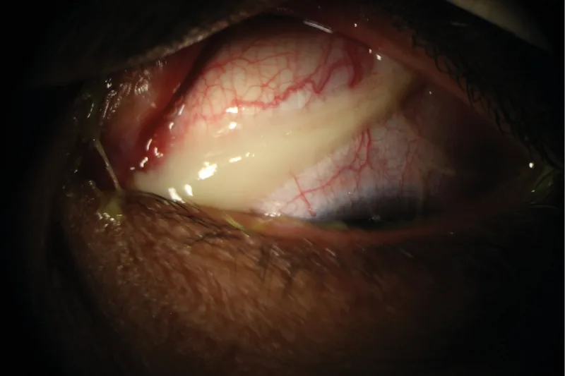 細菌性結膜炎の膿性眼脂