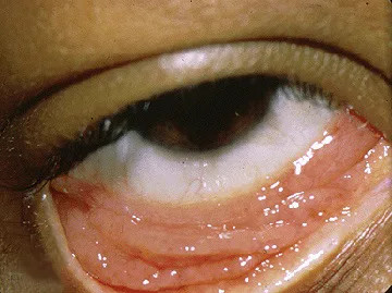 Klinisches Bild einer Chlamydienkonjunktivitis