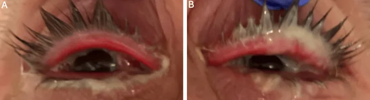 Reichlich eitriger Ausfluss bei Gonokokken-Konjunktivitis
