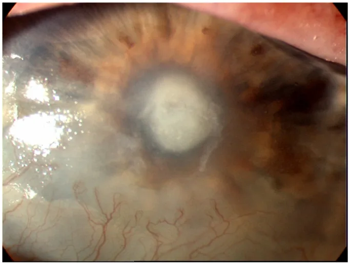 細菌性角膜炎の角膜潰瘍