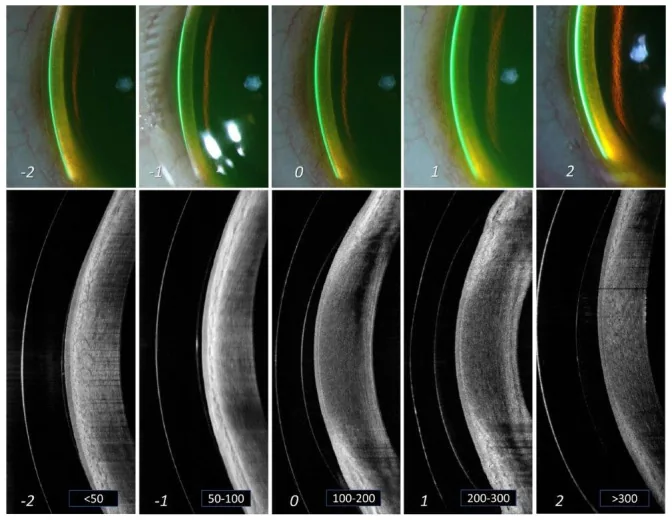 Gradazione del vault limbale delle lenti sclerali: confronto tra lampada a fessura e AS-OCT