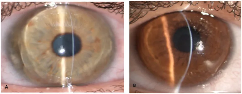 脆性角膜症候群の菲薄化した角膜