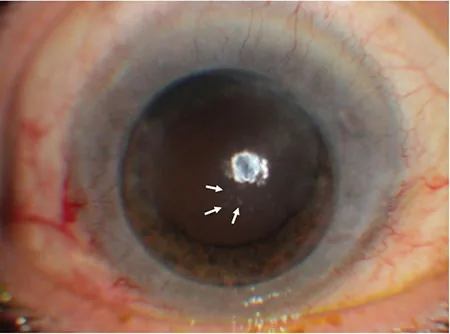 CMV角膜内皮炎のcoin-shaped KPs