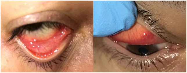 COVID結膜炎の濾胞性結膜反応