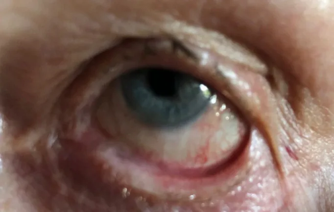 瘢痕性結膜炎のsymblepharon