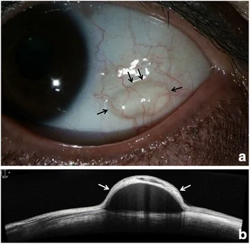 結膜封入嚢胞の前眼部写真とAS-OCT