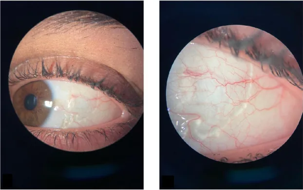 結膜リンパ管拡張症の透明な蛇行管
