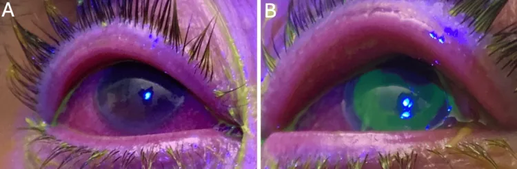 Conjunctivitis image