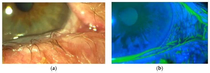 Conjunctivochalasis image