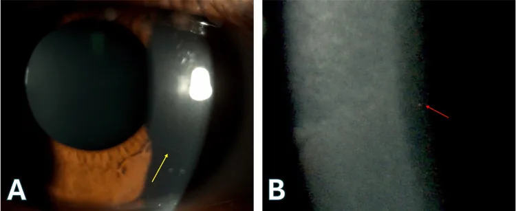 Cornea Farinata image
