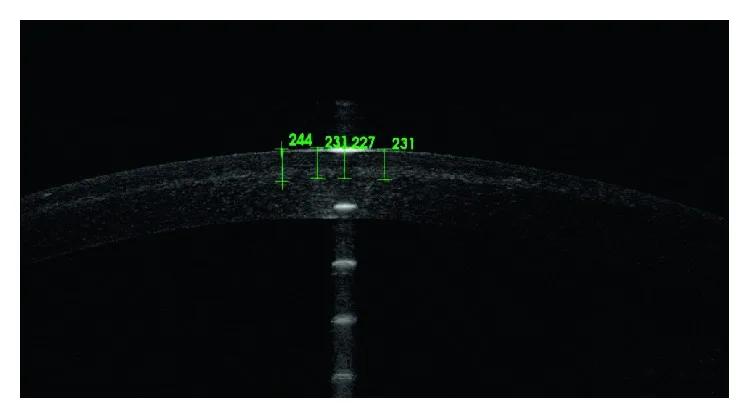 上皮剥離法クロスリンキング後の前眼部OCT断面。角膜実質内の境界線（デマルケーションライン）までの深さを緑のキャリパーで計測し、中央で227 μm。