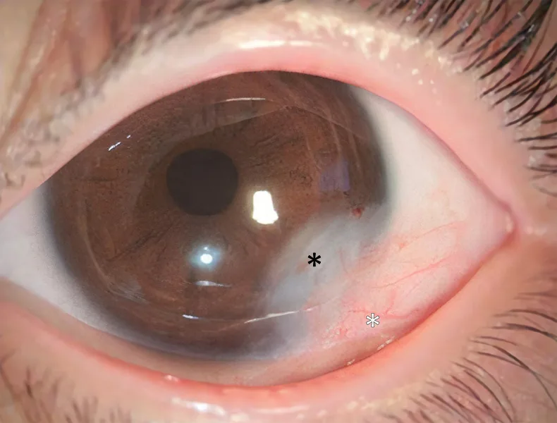 Corneal Dermoid image