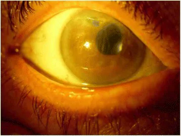 Corneal Edema image