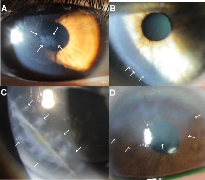 Corneal Epithelial Defect image