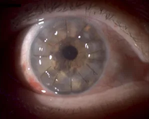 Corneal Leukoma image