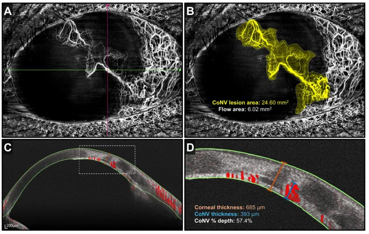 Corneal Neovascularization image