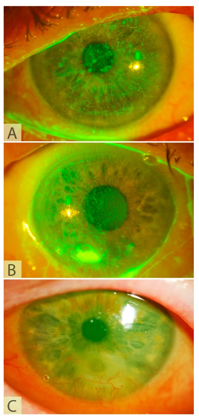 Corneal Neurotization for Neurotrophic Keratitis image
