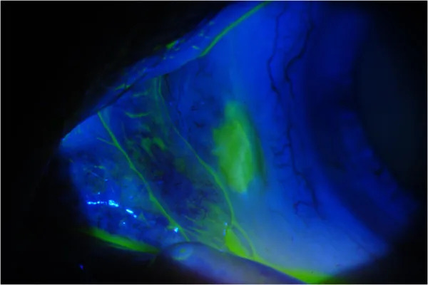 Cosmetic Wide Conjunctivectomy image
