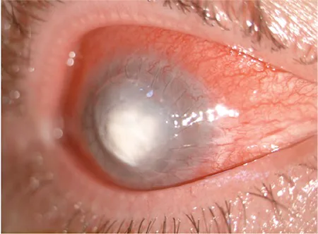 Cross Linking Related Infections image