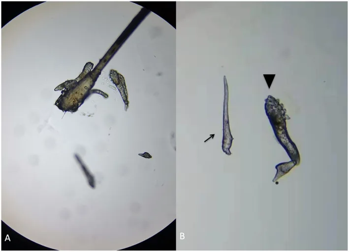 Demodeks blefaritinin mikroskobik görüntüsü. Kirpik folikülüne yapışmış Demodex vücutları ve yumurtaları görülüyor.