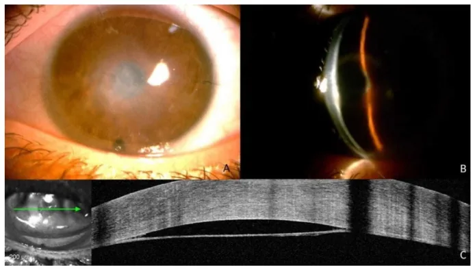 Descemet Membrane Detachment image