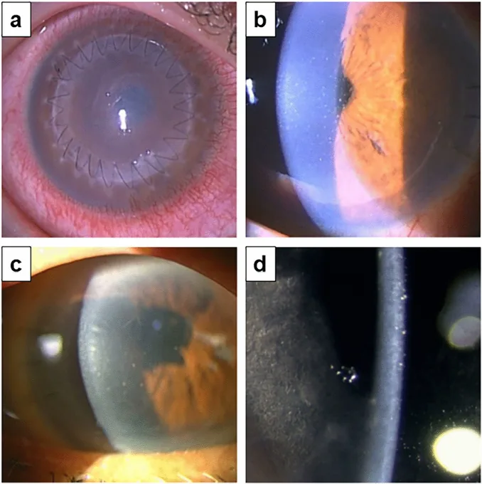 Descemet Membrane Endothelial Keratoplasty image