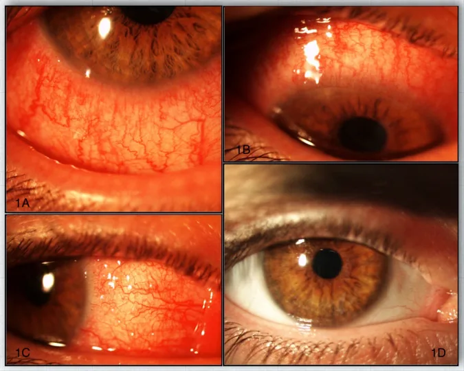 Dupilumab-Induced Conjunctivitis image