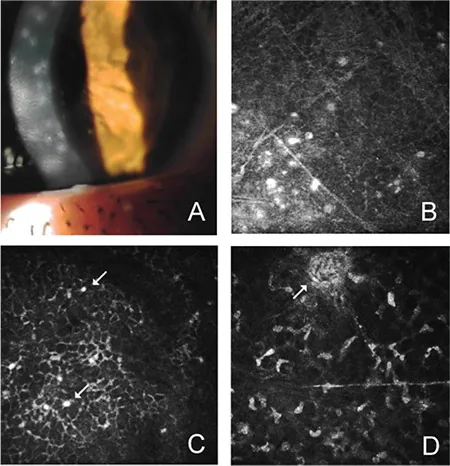 Epidemic Keratoconjunctivitis image