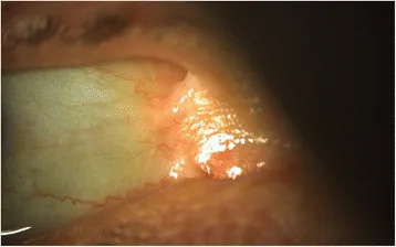 Epidermolysis Bullosa image