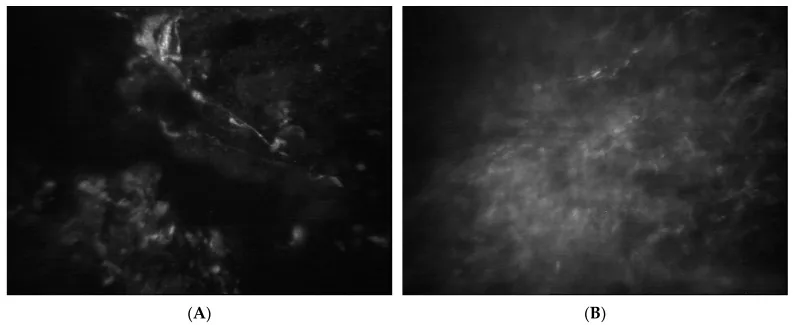 Fungal Keratitis image