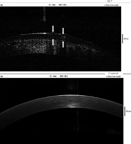 Gelatinous Drop-Like Corneal Dystrophy image