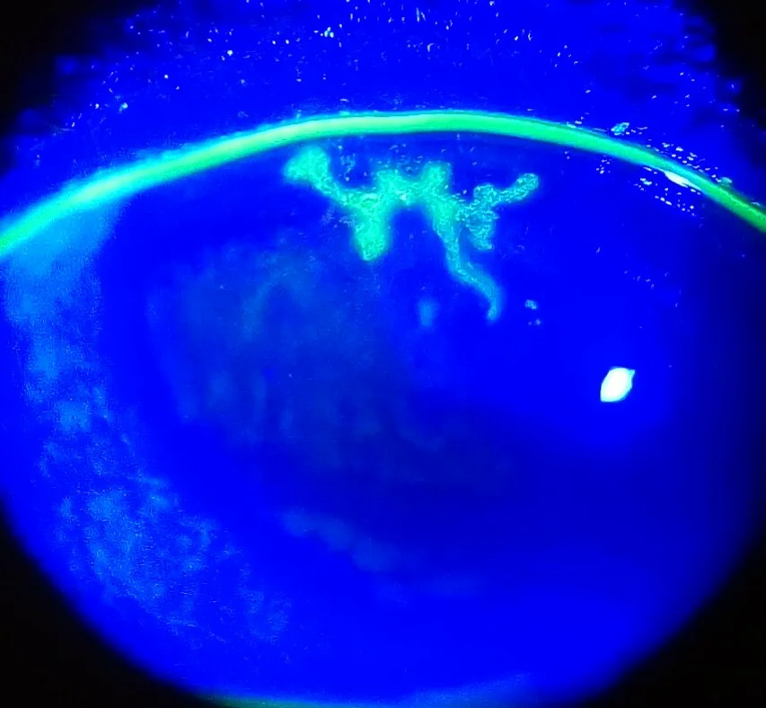 単純ヘルペス角膜炎の樹枝状潰瘍（フルオレセイン染色）