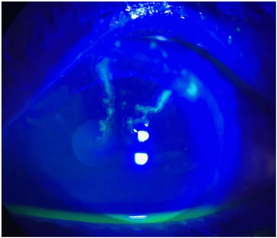 Herpes Zoster Ophthalmicus image