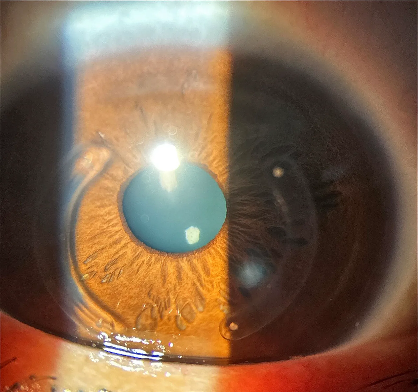 ICRS_ Corneal Biomechanics Effects image