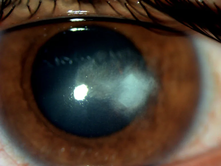 Infectious Crystalline Keratopathy image