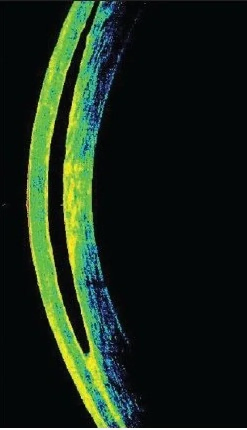 Interface Fluid Syndrome image